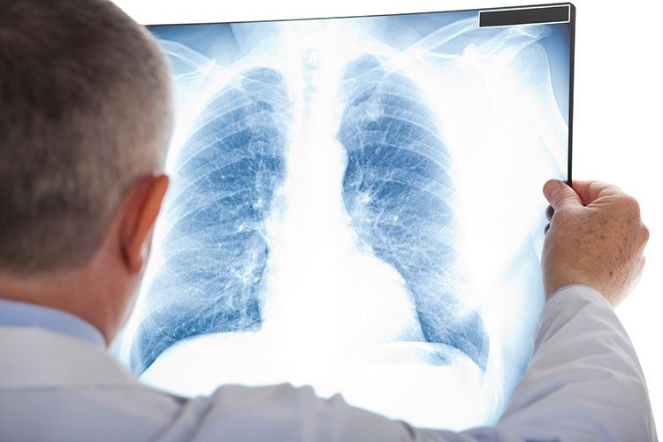 AdobeStock_54940412_Lung_Cancer